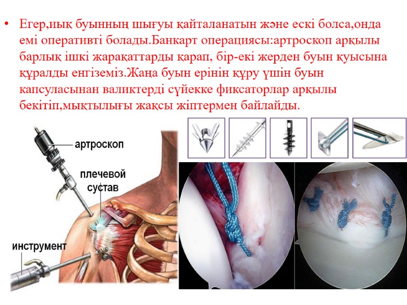 Егер,иық буынның шығуы қайталанатын және ескі болса,онда емі оперативті болады.Банкарт операциясы:артроскоп арқылы барлық ішкі